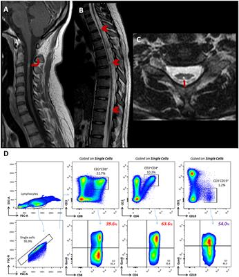 Case report: Granzyme-B expression by T- and B- cells during severe AQP4-positive Neuromyelitis Optica spectrum disorder with fatal venous thromboembolism outcome